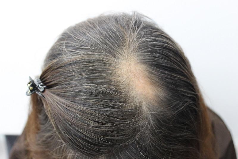 First year of scar hair transplant at Lizmo clinic in Busan