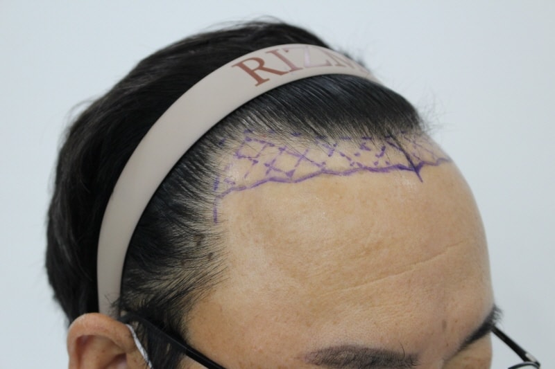 It's a late 8 months of 3,000 hair transplants for non-cutaneous hair transplants.