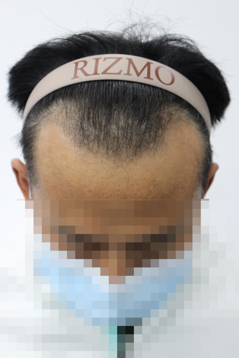 男士非切开毛发移植 8个月后期