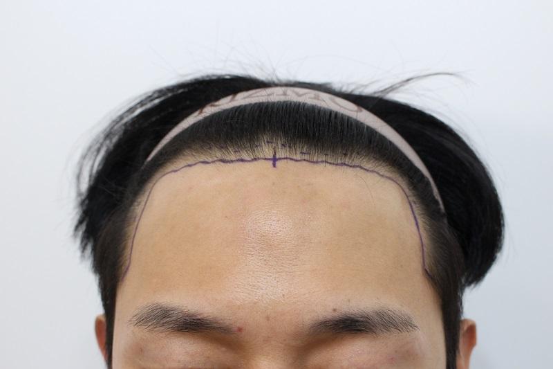 This is the 2nd week of hair transplantation at Lizmo Clinic in Busan