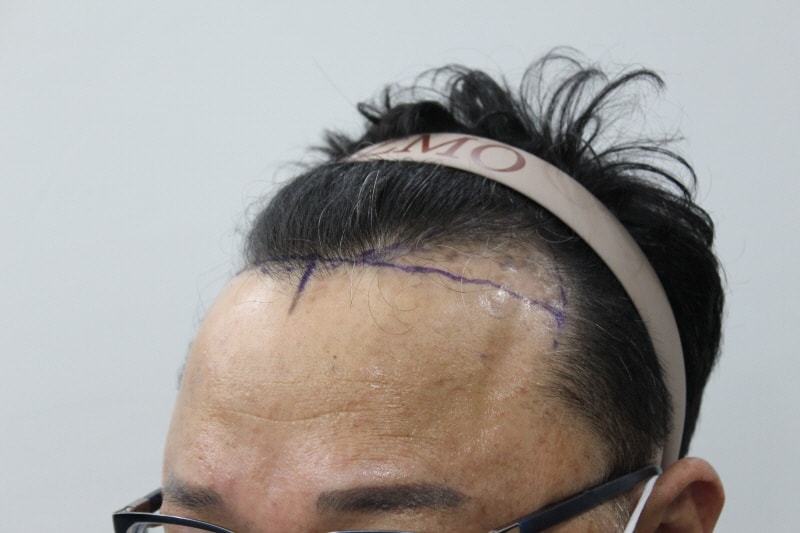[크기변환]수술전 옆모습.jpg