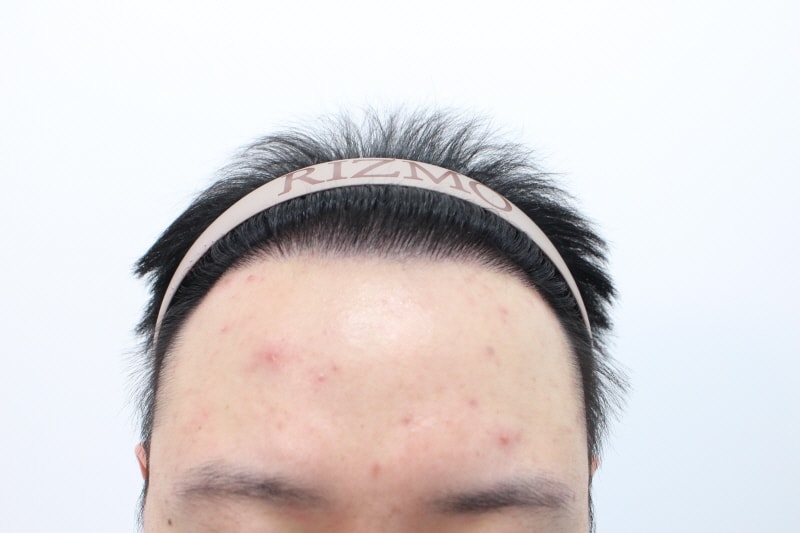 [크기변환]수술후 8개월 1.jpg