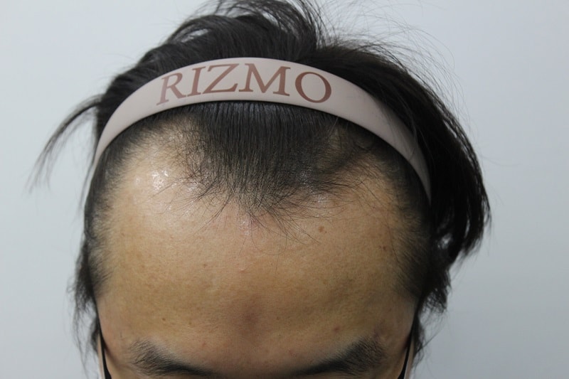 It's the 4th month of hair transplantation in Rizmo, Busan