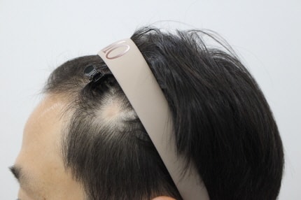 [크기변환]수술전 흉터부위.jpg