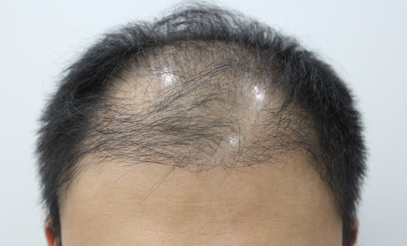 How is the 3rd month of hair transplantation in the 6000-mo 30s