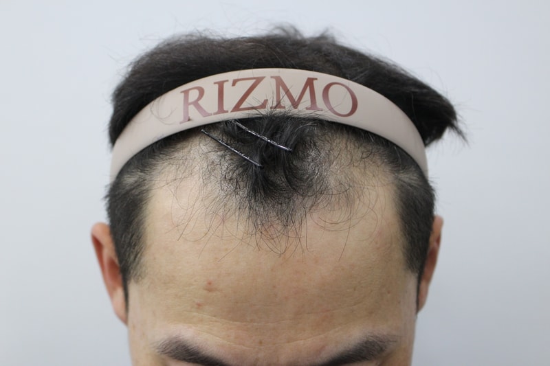 3,000 Mo Hair Transplantation Records Dark Age in 2 Months