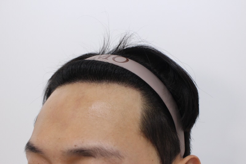3. 수술후 10개월차.jpg