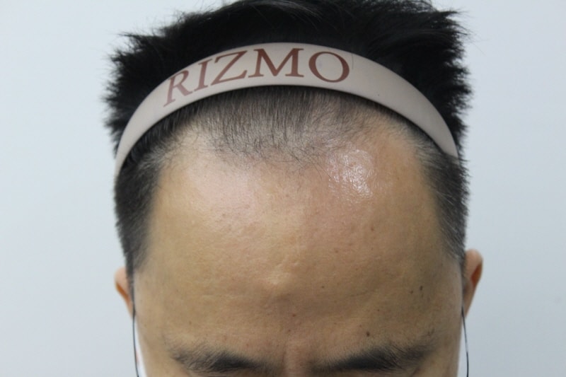 This is the 8th month of hair transplantation at Lizmo Clinic in Busan