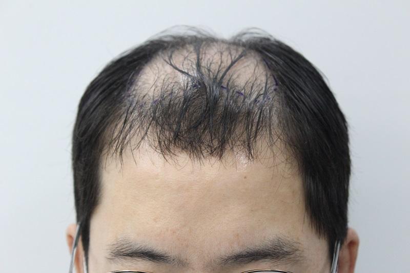 It's been 12 months since the pancreas hair transplant in Rizmo, Busan
