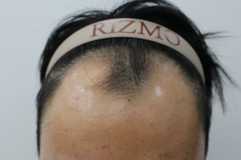 5000毛のヘアライン矯正、2週間経ちました~