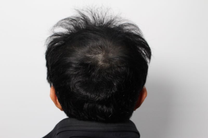 9.다음날 출근이여서 수술비는 2배내더라도 티않나는 무삭발로 해달라고 부탁드렸습니다. 감쪽같아서 좋았어요. .jpg