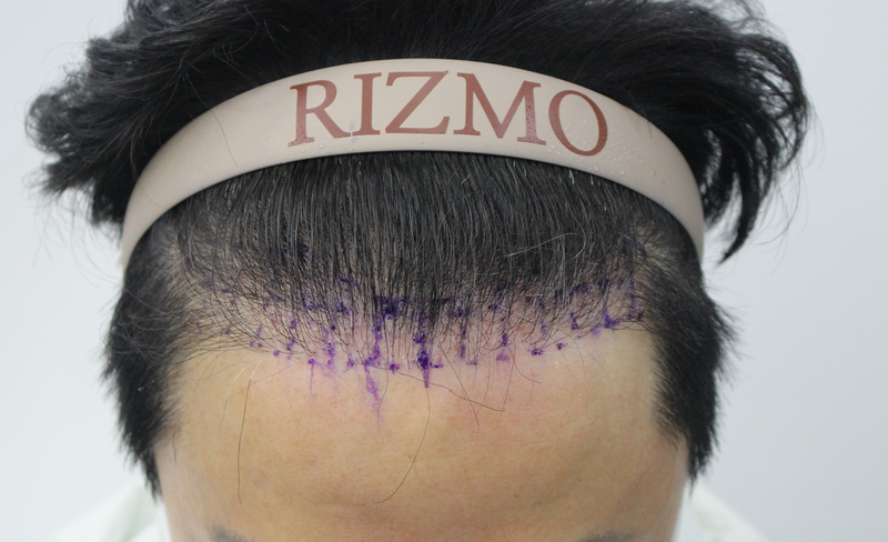 ヘアライン密度補強1400毛、もう4ヶ月ですね。