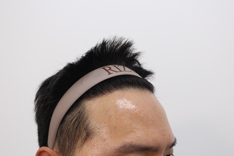 6. 수술후 8개월.jpg