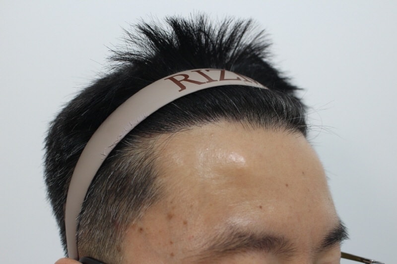 2[크기변환]수술후 240일차.jpg