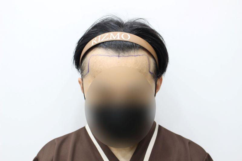 Lizmo Medical Center Daejeon Branch M-shaped Hairline 3500 Mo (No-cut-to-block) Hair Transplantation in the 2nd week