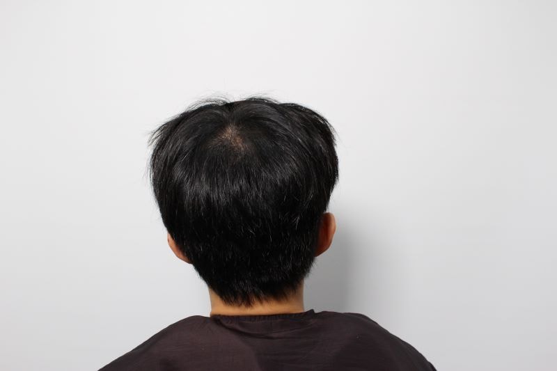4 리즈모의원 대전점에서 수술하고 나서 2주차된 뒷모습입니다. 티가 전혀 나질 않더라구요. .jpg