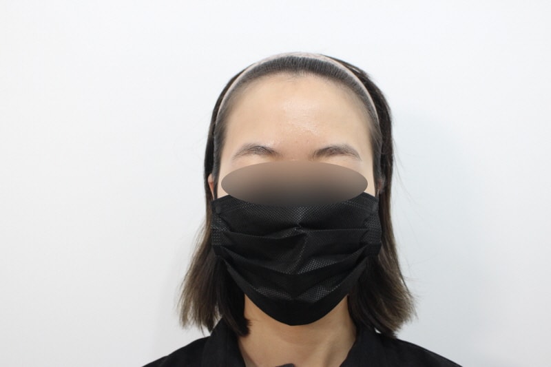 2[크기변환]수술전 휑~하던 큰 이마.jpg
