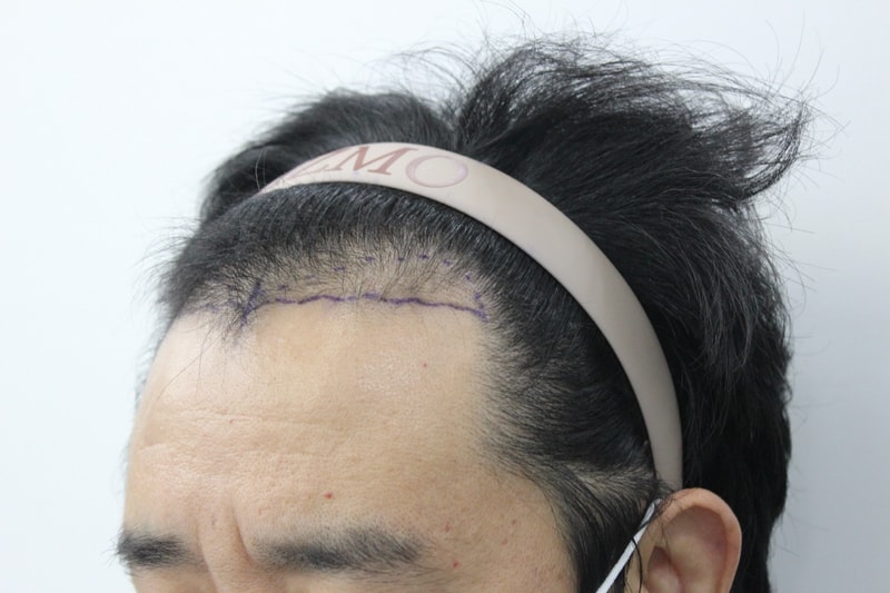 부산리즈모 비절개 1000모 8개월차
