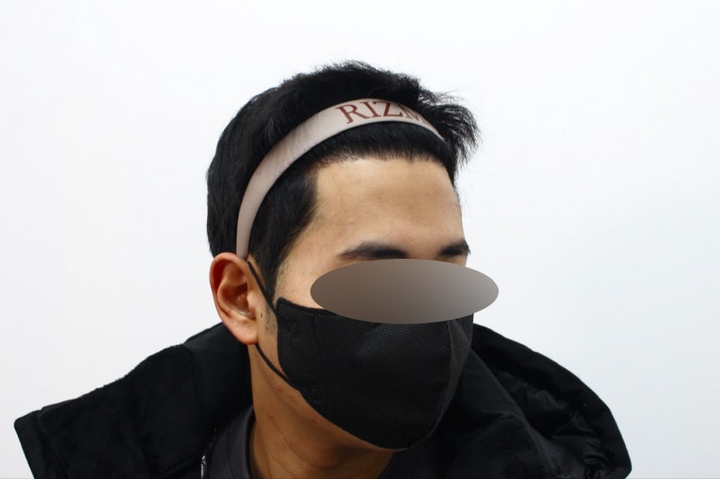 [크기변환]수술후1년차옆모습dd.jpg