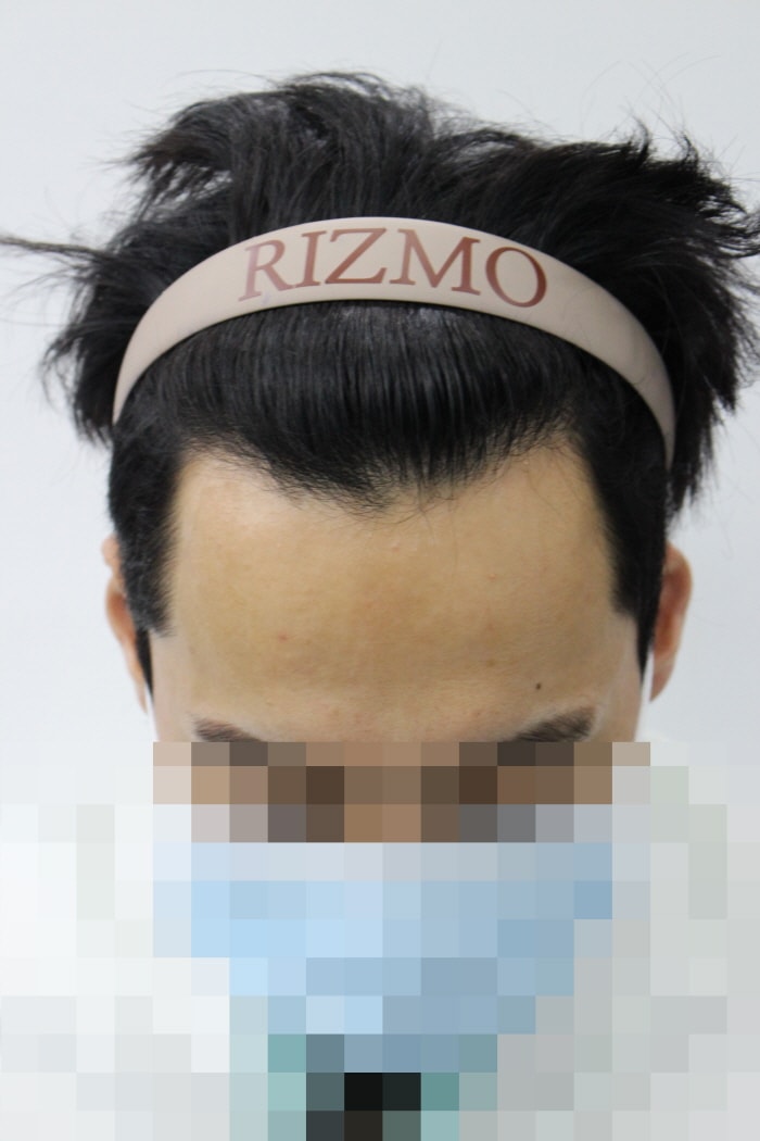 男士m字毛发移植 8个月后期！也可以做发蜡