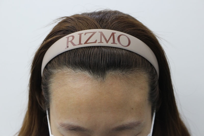 Women's m-shape hair loss 8 months review!