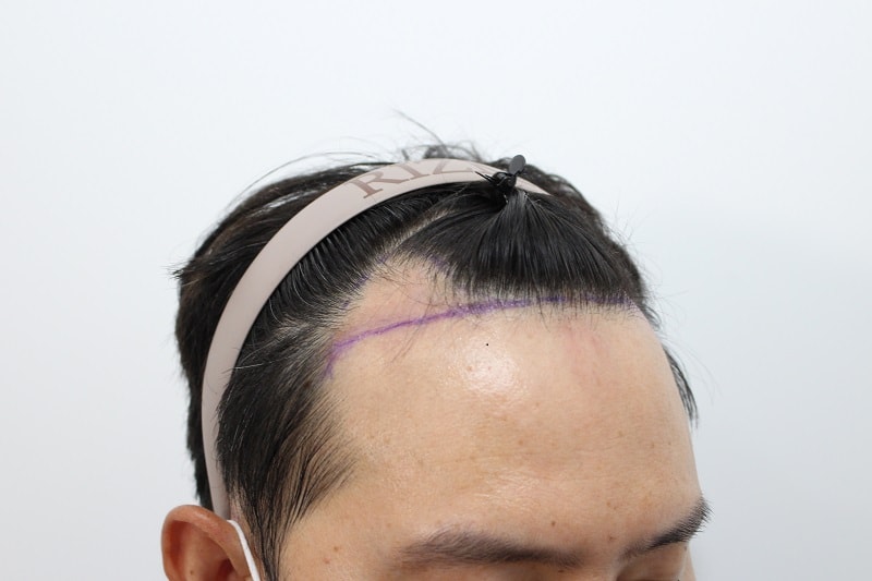 4. 수술전.jpg