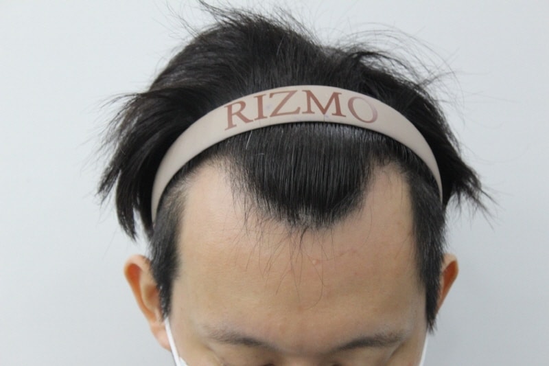 8th Month Review of Lizmo Clinic M-Shaped Hair Loss Transplantation at Lizmo Clinic in Busan