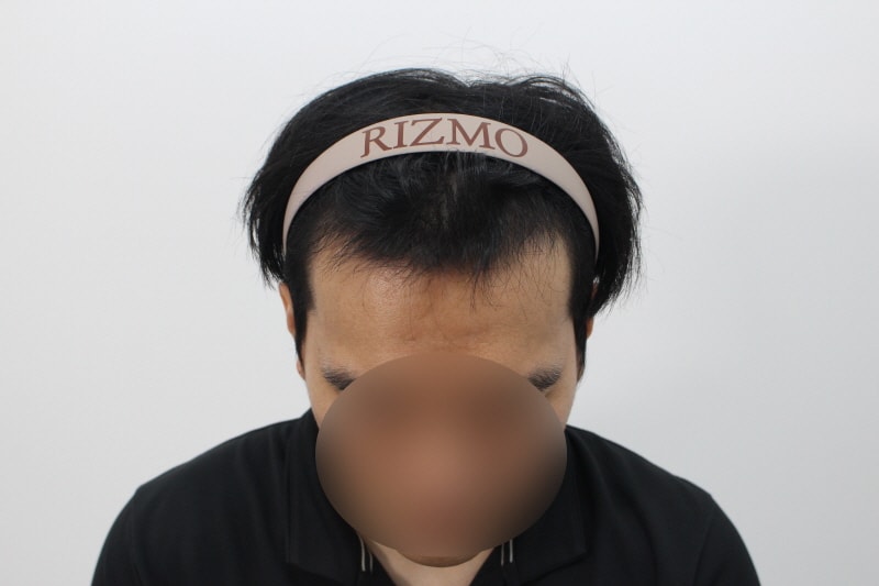 2[크기변환]수술 후 160일차 파인부위 메꿔지고 있는 헤어라인d.jpg