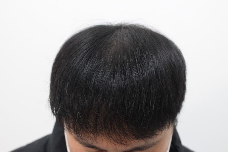 [크기변환]수술 후 11개월차.jpg