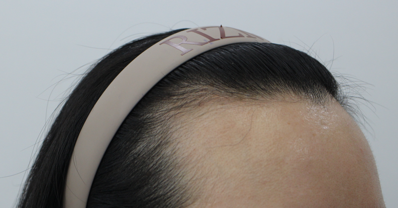 Women's Hairline Correction 20's 3000 Mo is 2 weeks old!