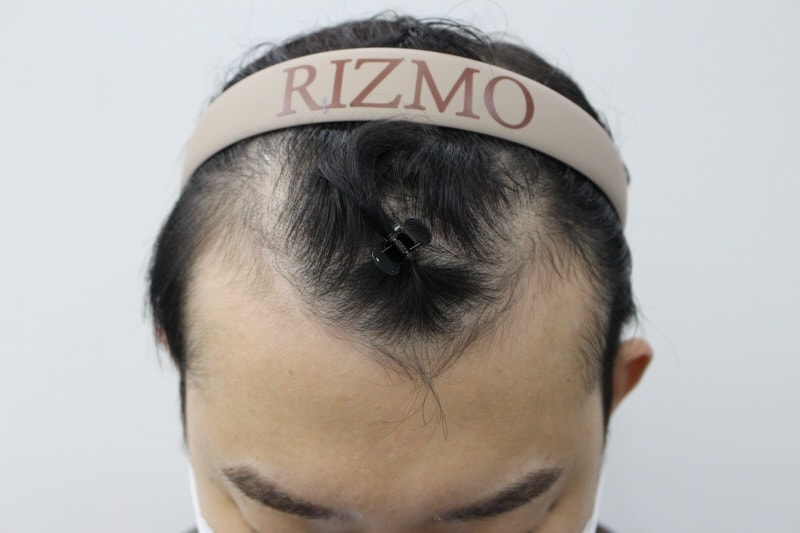This is the review of 7000mo in the first year of the Busan Lizmo incision.
