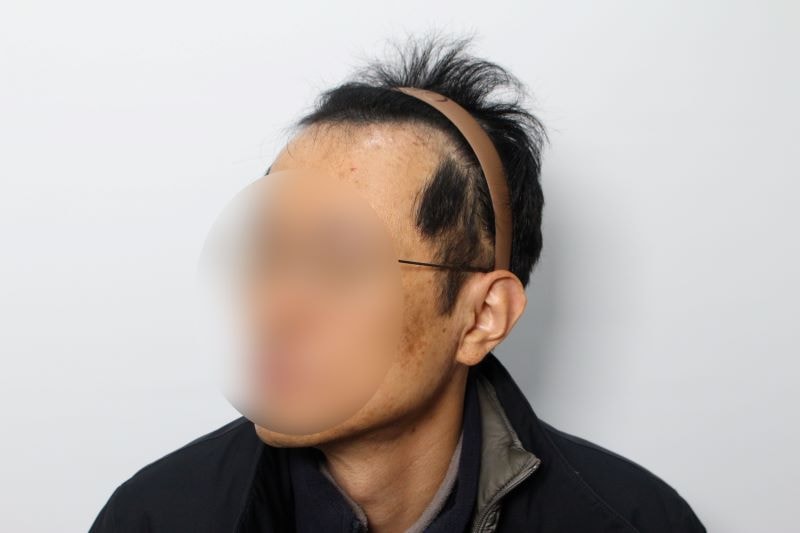 5.수술전 이렇게 심했던 M자탈모가.jpg