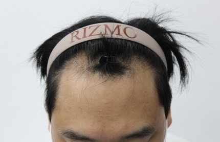 [Busan Lizmo] It's been 6 months since a man in his 30s had a non-cut hair transplant