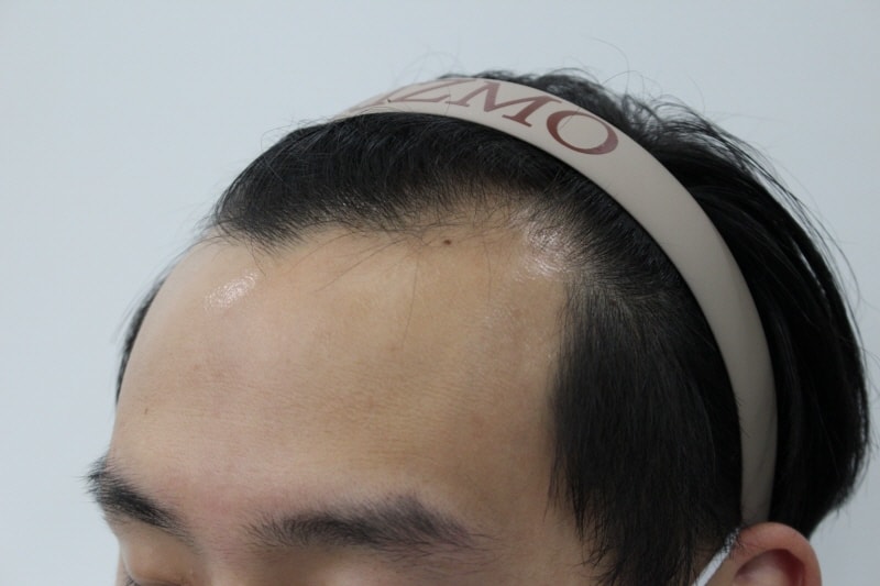 釜山Lizmo20代3400毛移植手术1年后期~