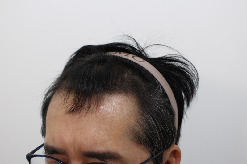 수술후 4개월.jpg