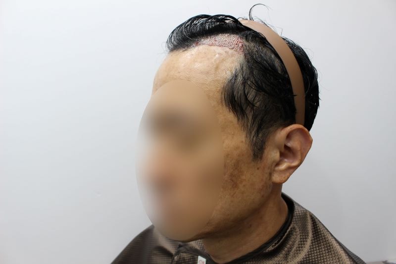 6.대전에서 모발이식 받고 옆모습도 채워지고.jpg