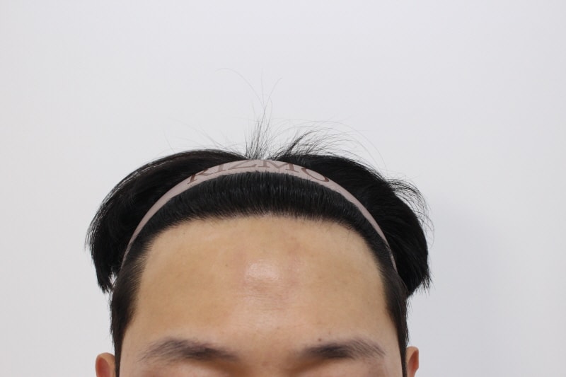 6. 수술후 10개월차.jpg