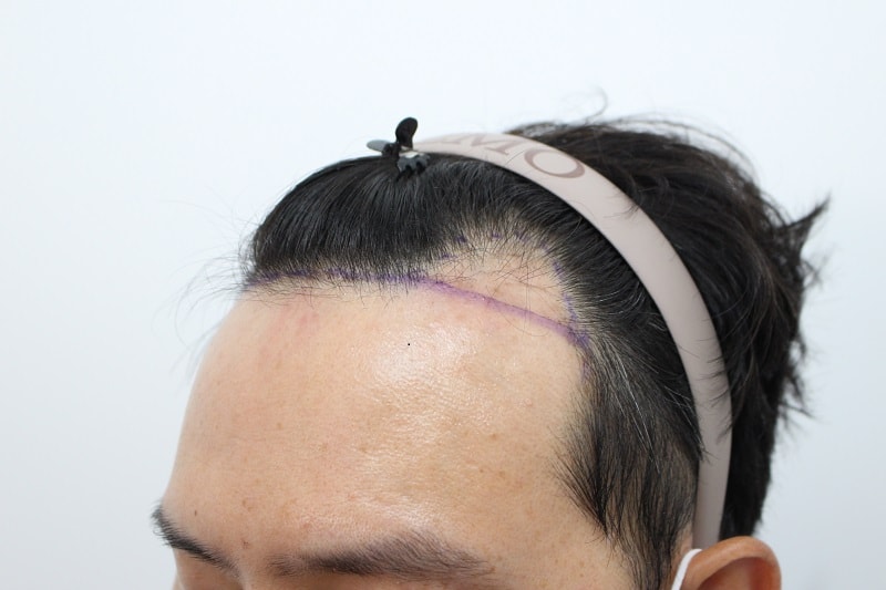 7. 수술전.jpg