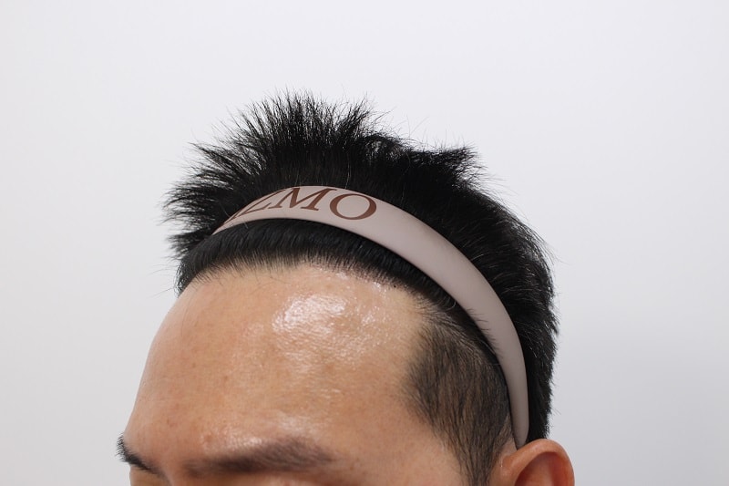 8. 수술후 8개월.jpg