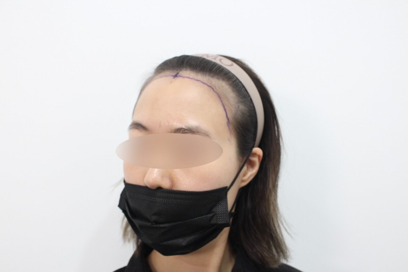 2[크기변환]수술 전 디자인 2.jpg