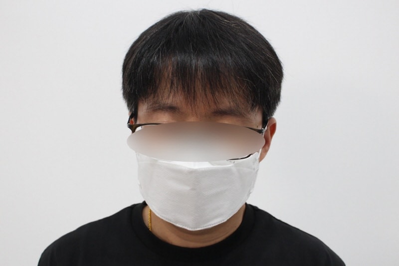 2[크기변환]수술후 1년차 머리를 내려도 자연스럽습니다d.jpg