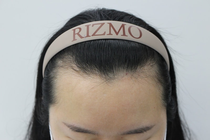 Record on the day of surgery at Lizmo Medical Center in Busan~365th day of surgery