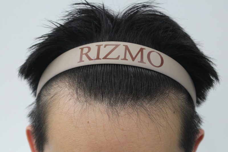 男性のヘアラインm字1200毛 矯正2週間！