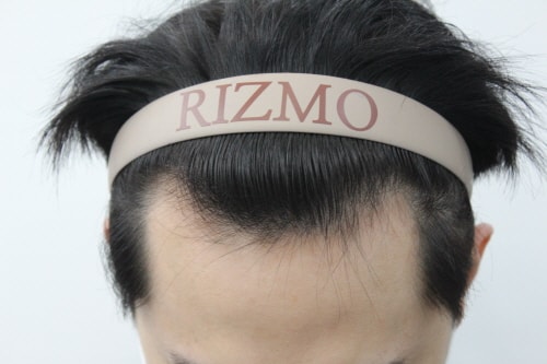 The review of the 2nd week of Emza hair loss in the 20s