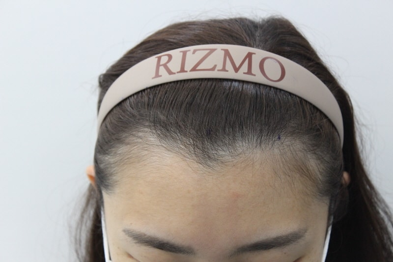 20代後半の女性m字毛髪移植ヘアライン一度見てください~~
