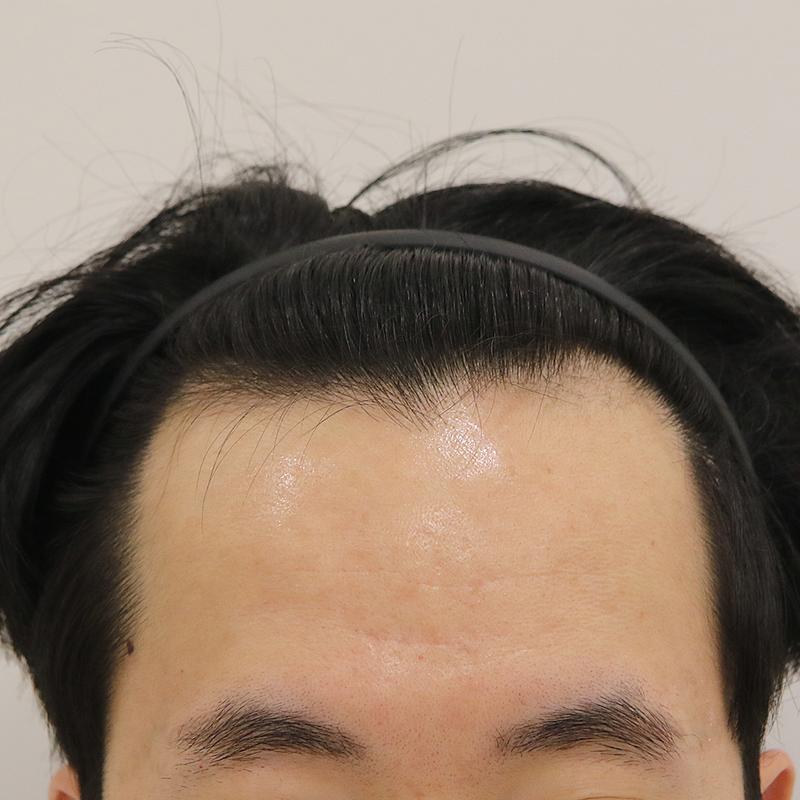 マンモスヘアライン釜山M字毛髪移植4ヶ月レビューです。