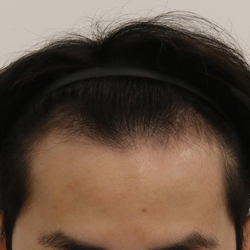 Mammoth Hairline Busan branch non-cut slit M-shaped transplant 5 months ago!