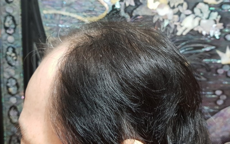 It's the first day of hair transplantation in 1860 hair follicles.