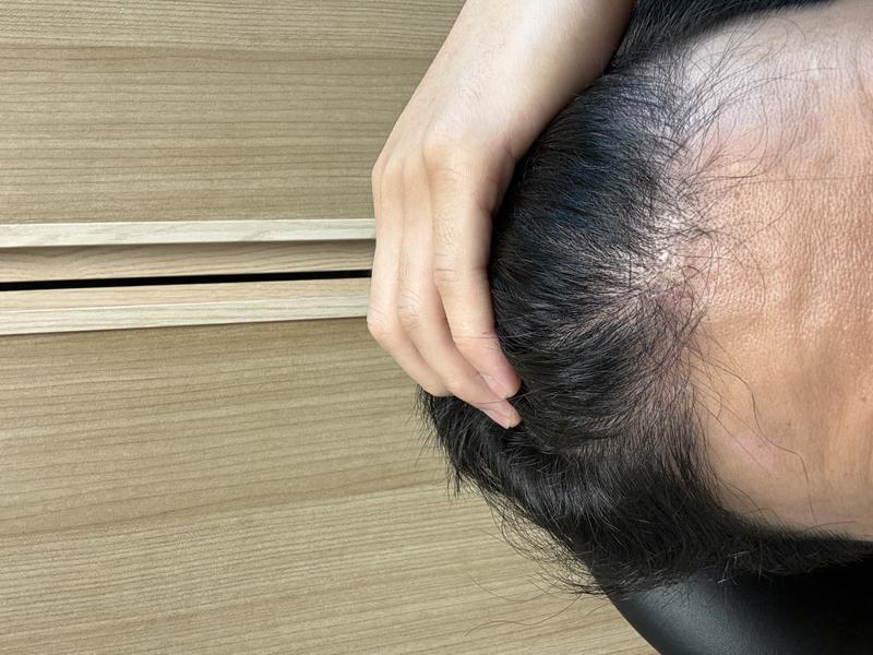 母材性 毛髪移植センター 男性 非切開 毛髪移植 850毛包 手術4ヵ月目 レビュー