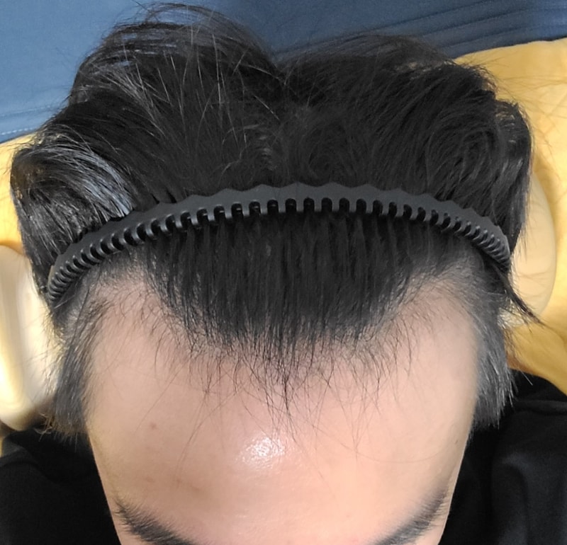 I post a review right after the 2,400-mo surgery in my late 20s